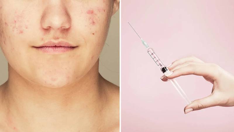 sivilceye karsi iki asi gelistiriliyor mrna denemesi ve enzim hedefli yaklasim 931yMVgw